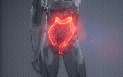 Animación sobre Apendicitis
