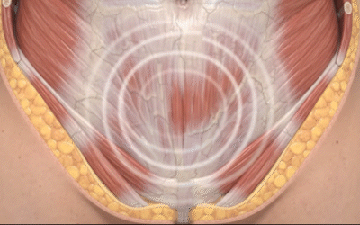 Animación ¿Tengo una hernia abdominal?